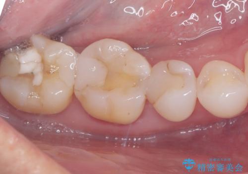 奥歯を美しくセラミック修復の治療前