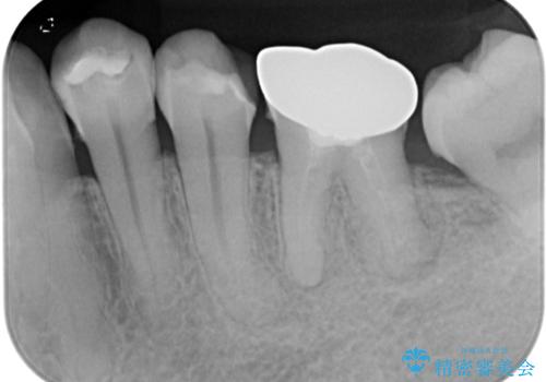 下顎大臼歯の再根管治療とオールセラミッククラウンによる補綴治療の治療前