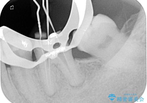 下顎大臼歯の再根管治療とオールセラミッククラウンによる補綴治療の治療中