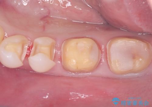 セラミックで叶える集中審美治療の治療中