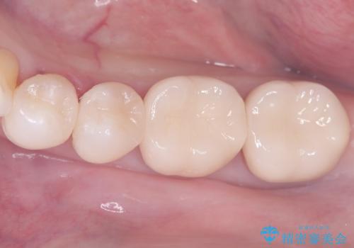 セラミックで叶える集中審美治療の症例 治療後