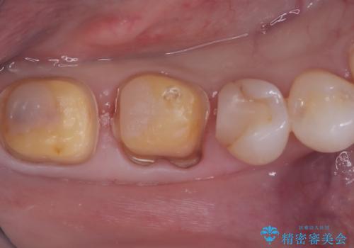 奥歯を美しくセラミック修復の治療中