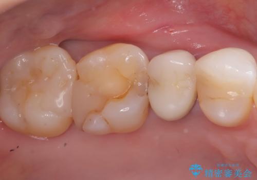 被せ物の黒ずみを美しく改善の治療前