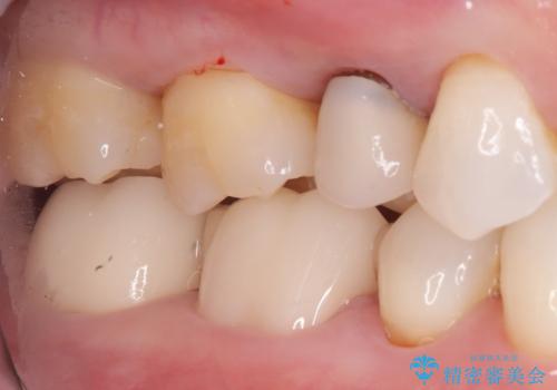 被せ物の黒ずみを美しく改善の治療前