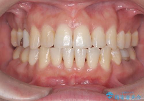 重度の叢生を抜歯矯正で改善|審美ワイヤー矯正+海外出張に伴う中断・再開対応の治療後