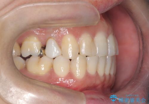 重度の叢生を抜歯矯正で改善|審美ワイヤー矯正+海外出張に伴う中断・再開対応の治療後