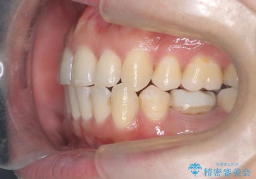 重度の叢生を抜歯矯正で改善|審美ワイヤー矯正+海外出張に伴う中断・再開対応の治療後