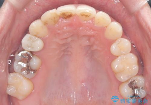 重度の叢生を抜歯矯正で改善|審美ワイヤー矯正+海外出張に伴う中断・再開対応の治療後