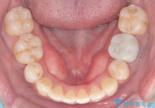 重度の叢生を抜歯矯正で改善|審美ワイヤー矯正+海外出張に伴う中断・再開対応の治療後