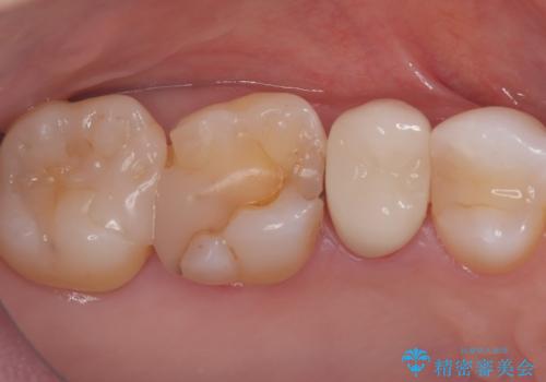 被せ物の黒ずみを美しく改善の治療後