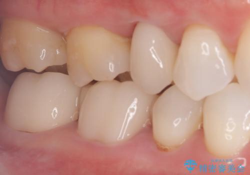 被せ物の黒ずみを美しく改善の治療後