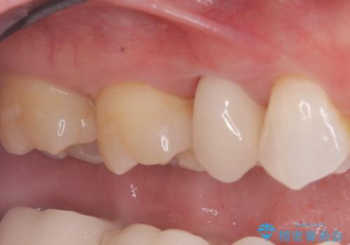 被せ物の黒ずみを美しく改善の治療後
