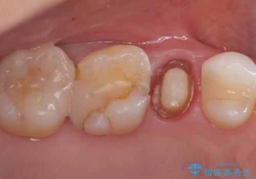 被せ物の黒ずみを美しく改善の治療中