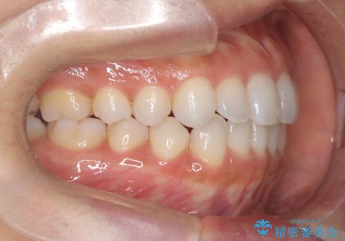 前歯の叢生を非抜歯で改善|インビザライン+IPR・遠心移動・FIX保定の治療後