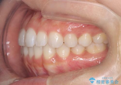 前歯の叢生を非抜歯で改善|インビザライン+IPR・遠心移動・FIX保定の治療後