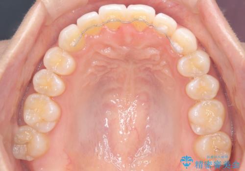 前歯の叢生を非抜歯で改善|インビザライン+IPR・遠心移動・FIX保定の治療後