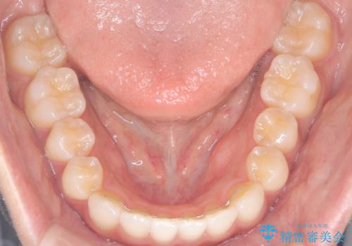 前歯の叢生を非抜歯で改善|インビザライン+IPR・遠心移動・FIX保定の治療後