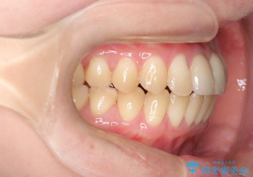 前歯の開咬とシザーズバイトを改善|インビザライン矯正の治療後