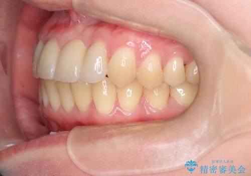 前歯の開咬とシザーズバイトを改善|インビザライン矯正の治療後