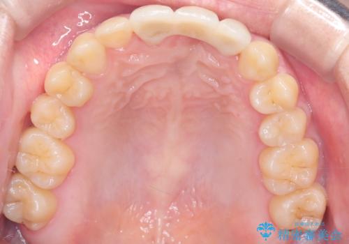 前歯の開咬とシザーズバイトを改善|インビザライン矯正の治療後