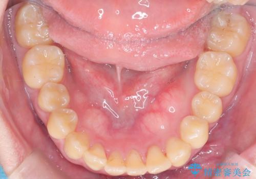 前歯の開咬とシザーズバイトを改善|インビザライン矯正の治療後