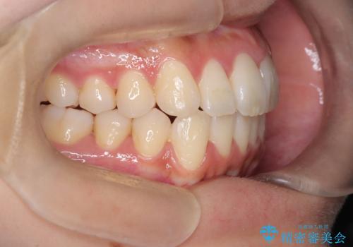 前歯の叢生・Ⅱ級咬合を改善|TADを用いた遠心移動+インビザライン矯正の治療後