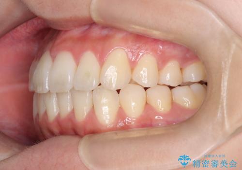 前歯の叢生・Ⅱ級咬合を改善|TADを用いた遠心移動+インビザライン矯正の治療後