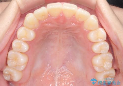 前歯の叢生・Ⅱ級咬合を改善|TADを用いた遠心移動+インビザライン矯正の治療後