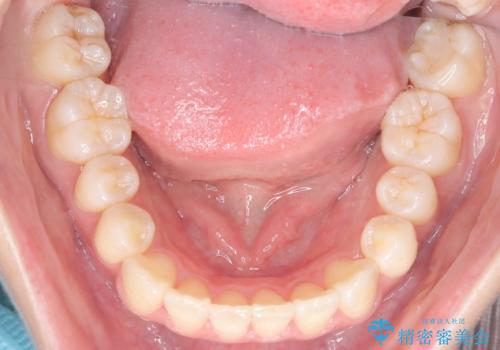 前歯の叢生・Ⅱ級咬合を改善|TADを用いた遠心移動+インビザライン矯正の治療後