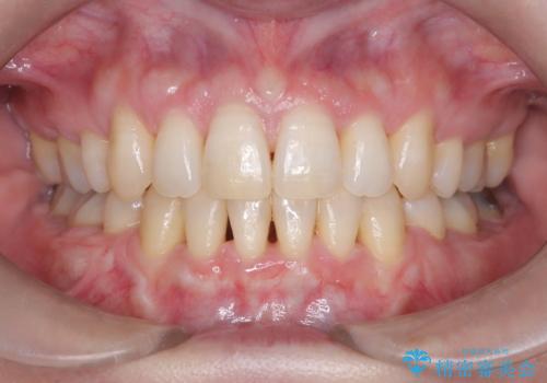 抜歯を伴う審美ワイヤー矯正の治療後