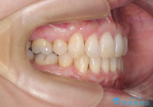 抜歯を伴う審美ワイヤー矯正の治療後