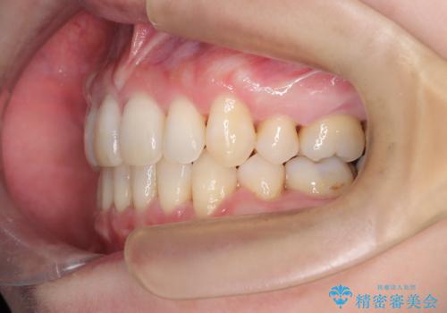 抜歯を伴う審美ワイヤー矯正の治療後