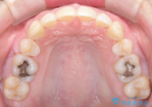 抜歯を伴う審美ワイヤー矯正の治療後