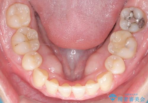 抜歯を伴う審美ワイヤー矯正の治療後