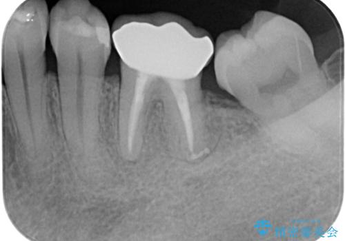 下顎大臼歯の再根管治療とオールセラミッククラウンによる補綴治療の治療後