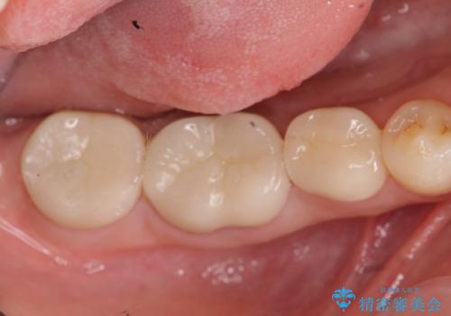歯冠長延長術・骨隆起除去を行った、スペースの少ないセラミック治療の治療後