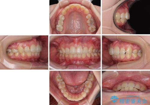 飛び出した前歯 抜歯矯正で横顔が劇的変化の治療後