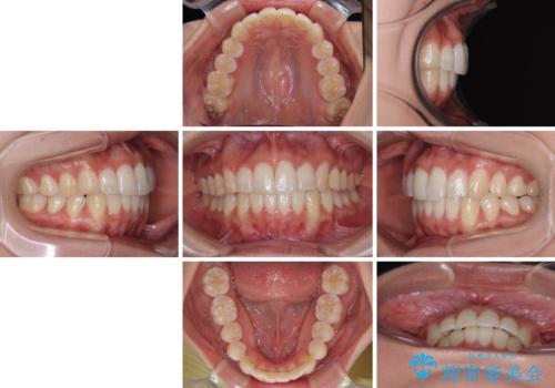 前歯のデコボコを治したい　インビザライン矯正の治療後