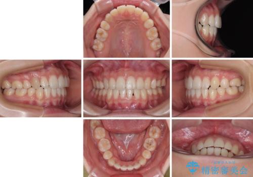 横顔の印象を変えたい ワイヤー装置での抜歯矯正の治療後