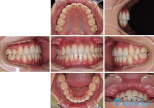 【モニター】デコボコ前歯をワイヤー装置での抜歯矯正で改善の治療後