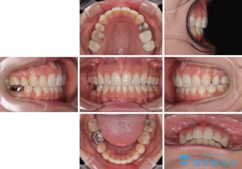 出っ歯と奥歯のむし歯 ワイヤー装置での抜歯矯正とセラミック治療の治療後