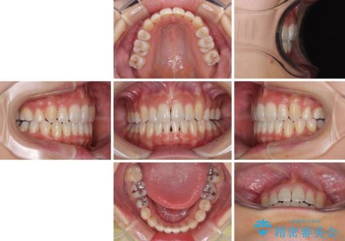 八重歯を改善 ワイヤー装置での抜歯矯正の治療後