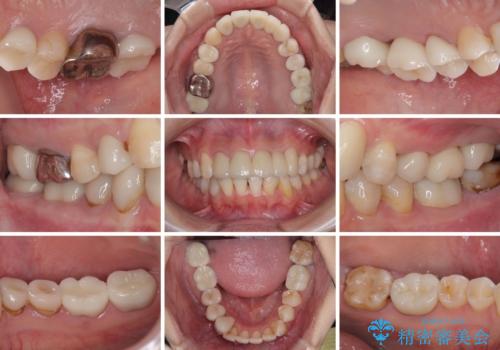 以前の治療箇所が痛む 全顎的なむし歯治療の治療後