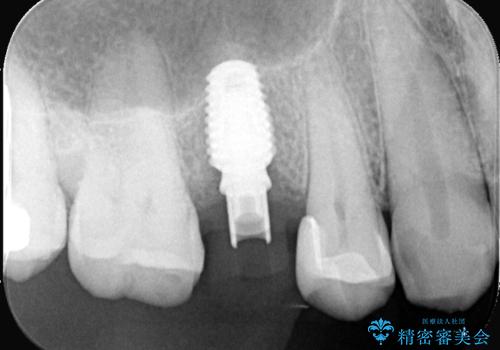 低侵襲なインプラント|痛くないインプラント|エンドペリオ病変|虫歯治療|セラッミクインレーの治療中