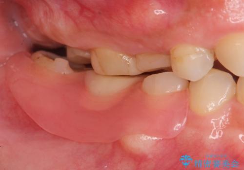 審美性に優れるノンクラスプデンチャーの治療後