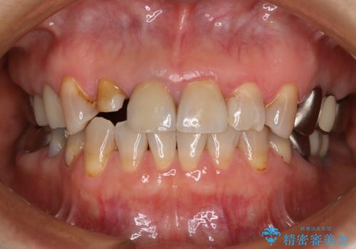 前歯を綺麗にしたい オールセラミッククラウンの治療中