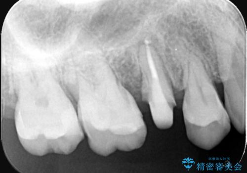 被せ物の黒ずみを美しく改善の治療前