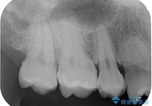 金属の詰め物がとれたので虫歯治療をしたい セラミックインレー修復の治療前