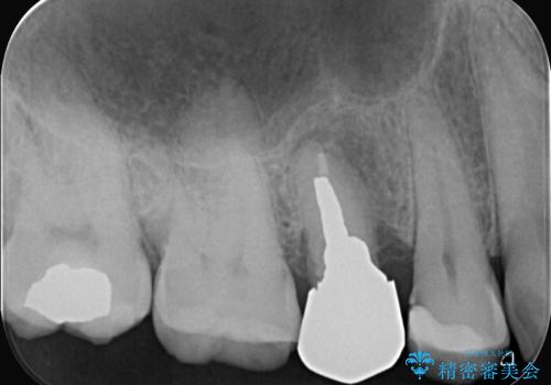 低侵襲なインプラント|痛くないインプラント|エンドペリオ病変|虫歯治療|セラッミクインレーの治療前