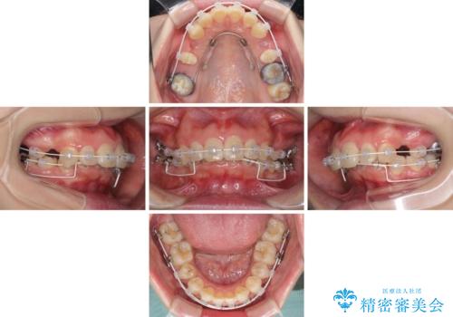 飛び出した前歯 抜歯矯正で横顔が劇的変化の治療中